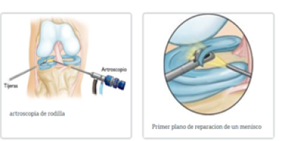 Desgarros de los meniscos