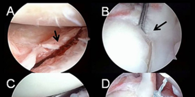 Inestabilidad de Hombro (Glenohumeral)